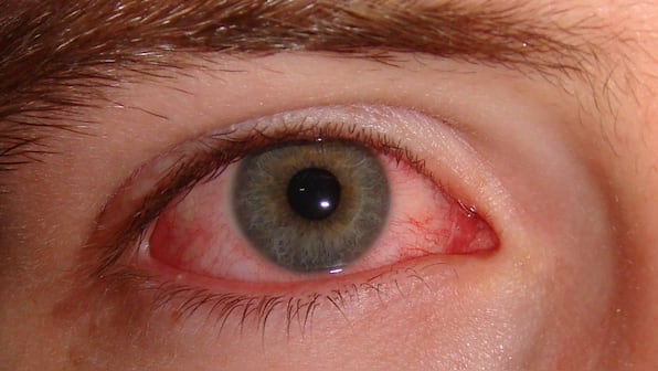 What is the ‘bleeding eye’ virus that has killed 15 in Rwanda?