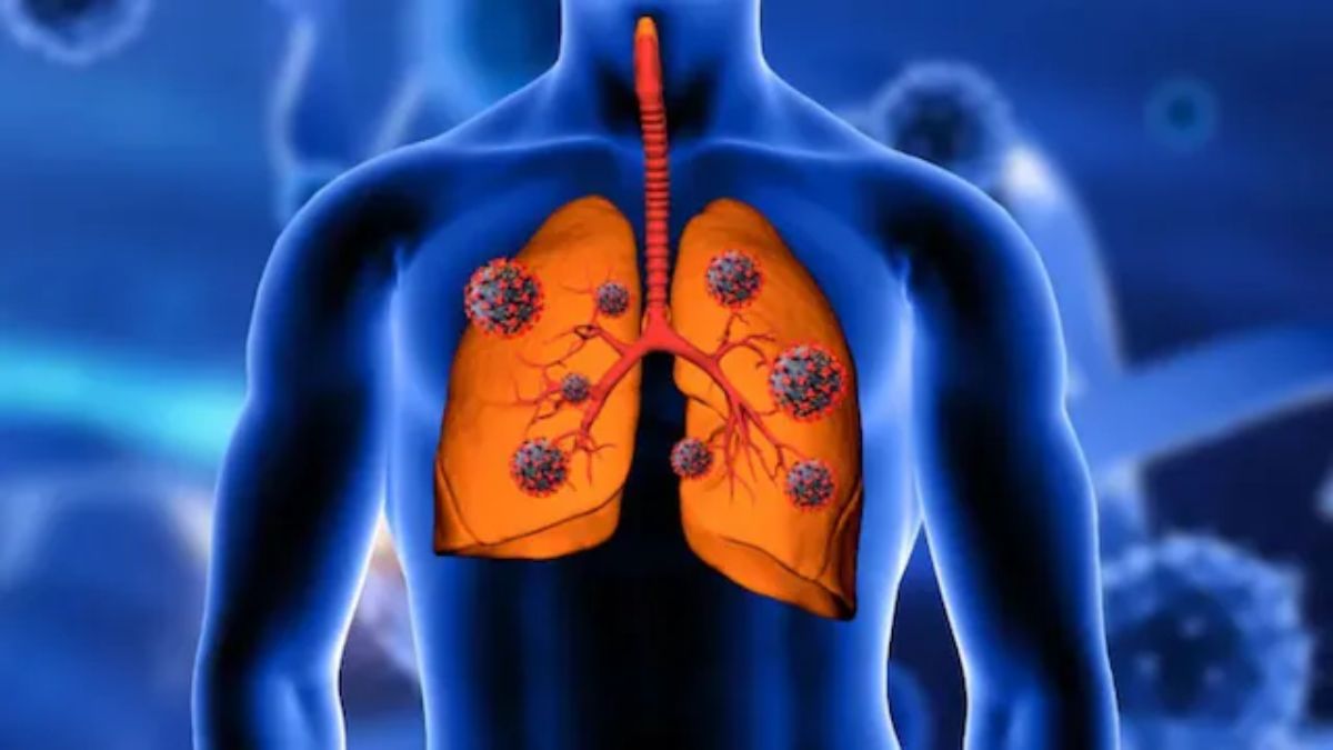 What’s causing lung cancer in non-smokers? – Firstpost What’s causing lung cancer in non-smokers? – Firstpost