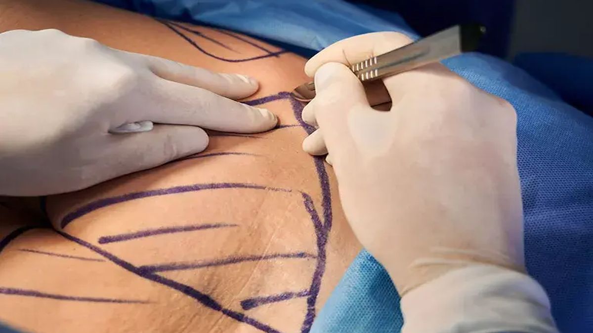 Lost the weight but struggling with loose skin? How many are opting to get rid of it Lost the weight but struggling with loose skin? How many are opting to get rid of it