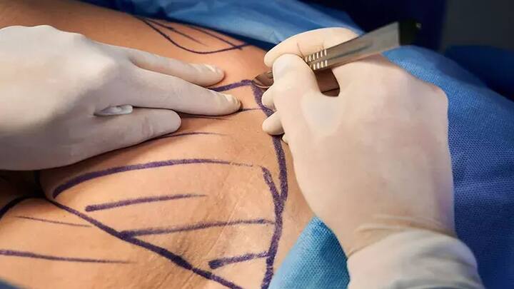 Lost the weight but struggling with loose skin? How many are opting to get rid of it Lost the weight but struggling with loose skin? How many are opting to get rid of it