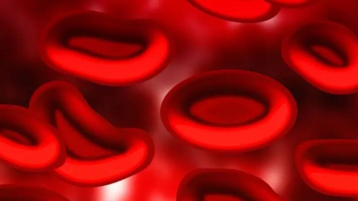 National Anaemia Day: When should anaemia patients consider a bone marrow transplant? National Anaemia Day: When should anaemia patients consider a bone marrow transplant?