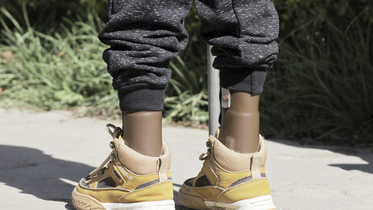 A young boy who lost his leg during the recent war walks with his mother during a visit at Ortho-Physiotherapy Centre in Mekele, Tigray, Ethiopia Friday, Feb. 14, 2025. (AP Photo/Amanuel Birhane) A young boy who lost his leg during the recent war walks with his mother during a visit at Ortho-Physiotherapy Centre in Mekele, Tigray, Ethiopia Friday, Feb. 14, 2025. (AP Photo/Amanuel Birhane)