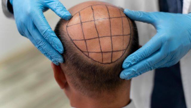 hair transplant 