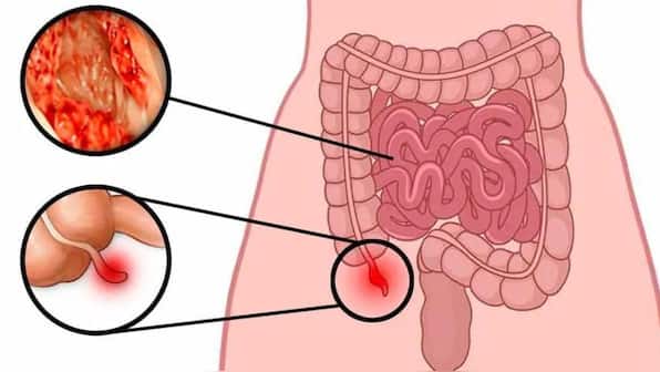 Doctor explains: Why appendix cancer is rising among the young and how it differs from colon cancer