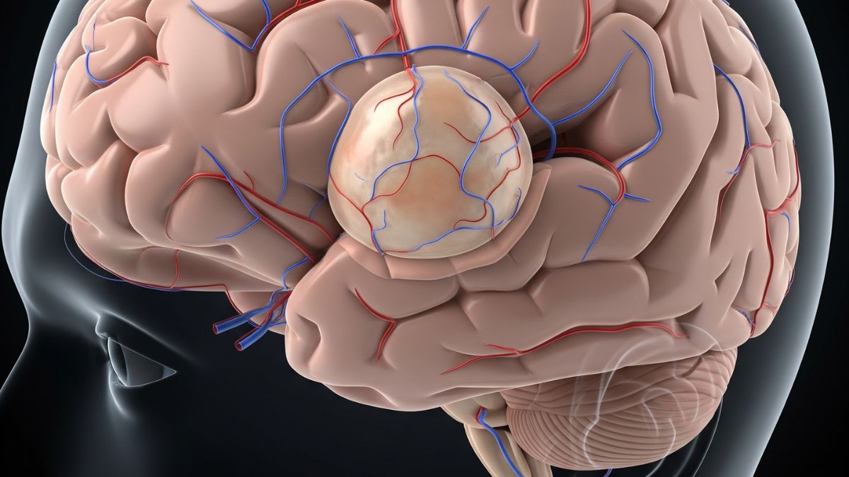 World Brain Tumour Day: Can mobile phones and radiation cause brain tumours? World Brain Tumour Day: Can mobile phones and radiation cause brain tumours?