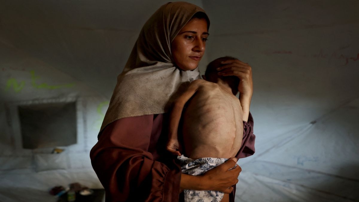 Hunger or disease? What’s the truth behind the viral image of starving child from Gaza?