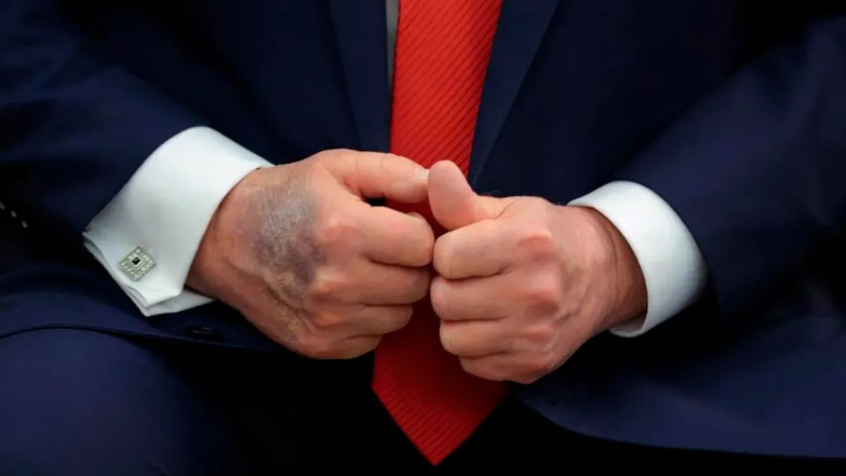A bruise is visible on the back of US President Donald Trump's right hand during a meeting with South Korean President Lee Jae-myung in the Oval Office at the White House on August 25, 2025 in Washington, DC.  A bruise is visible on the back of US President Donald Trump's right hand during a meeting with South Korean President Lee Jae-myung in the Oval Office at the White House on August 25, 2025 in Washington, DC.