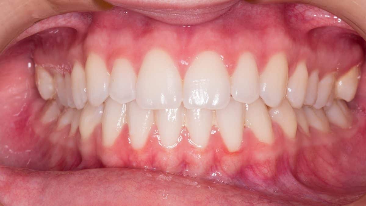 Humans Have Two Sets of Teeth for Lifelong Chewing