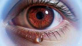 Doctor explains: Why winter raises the risk of dry eye, blepharitis and UV damage
