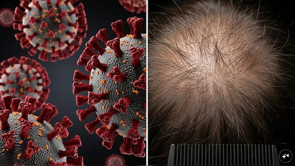Post-Covid hair fall haunts Indians: Doctors decode the long-term shedding crisis
