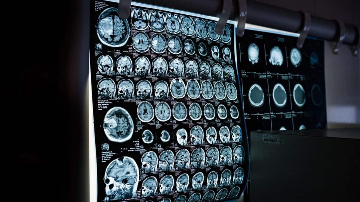 Some people have Alzheimer’s but no symptoms, finds new study — scientists wonder why