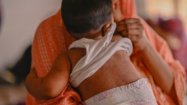 While Bangladesh routinely vaccinates infants as young as 9 months old against measles, unfortunately many of those infected during the current wave are under the age of nine months. AP