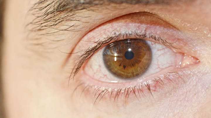 Why pink eye spreads so quickly and what you can do to prevent it
