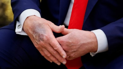A view of Donald Trump's bruised hands. The US president's health has been in focus since he has returned to the White House in 2025. File image/Reuters