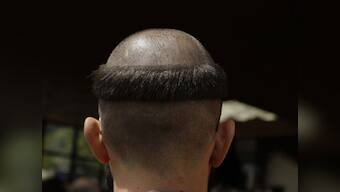 Hair now, gone tomorrow? A dose may do wonders