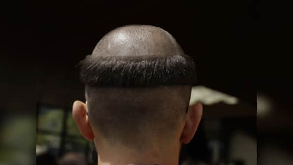 Hair now, gone tomorrow? A dose may do wonders