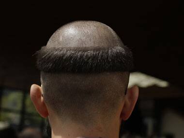 Hair now, gone tomorrow? A dose may do wonders