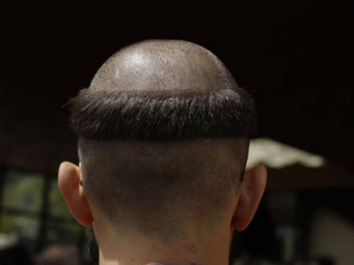Hair now, gone tomorrow? A dose may do wonders