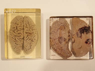 albert einstein brain vs normal brain