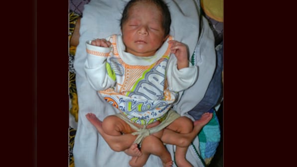 Six-legged baby born in Pak, doctors fight to save life