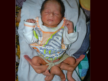 Six-legged baby born in Pak, doctors fight to save life Six-legged baby born in Pak, doctors fight to save life