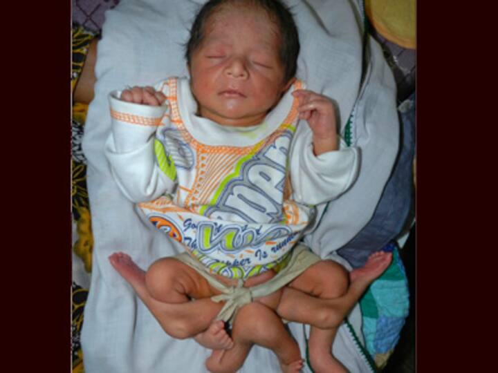 Six-legged baby born in Pak, doctors fight to save life