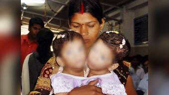 Conjoined twins separated after 12-hour surgery in MP