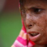 Acid-attack victim wants medical support or euthanasia