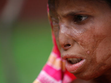 Acid-attack victim wants medical support or euthanasia Acid-attack victim wants medical support or euthanasia