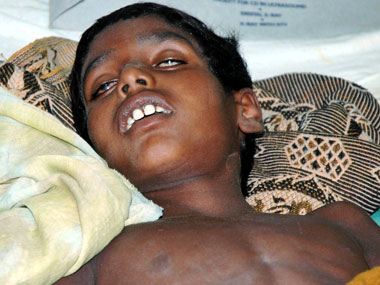 Encephalitis kills 299 children in Bihar this year Encephalitis kills 299 children in Bihar this year