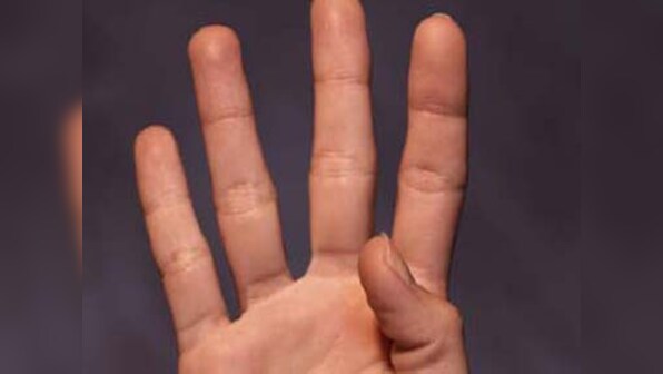 Length of ring finger can tell you if you will survive cancer