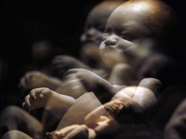 Now, a blood test can detect Down's syndrome in unborn babies Now, a blood test can detect Down's syndrome in unborn babies