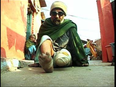 World Leprosy Day 2022: All you need to know about the theme, history and significance World Leprosy Day 2022: All you need to know about the theme, history and significance