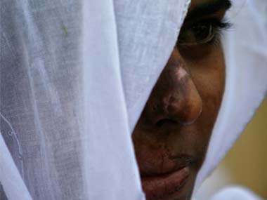 Sonali to Vinodhini: When will acid attacks end in India? Sonali to Vinodhini: When will acid attacks end in India?