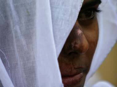 Sonali to Vinodhini: When will acid attacks end in India?