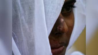 Reality of India's women: Acid attack victim has no funds for treatment