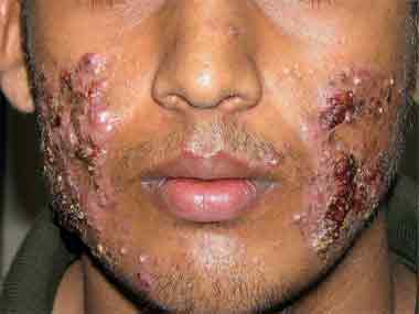 Image courtesy Facebook page: No steroid cream on face without a Dermatologist's prescription