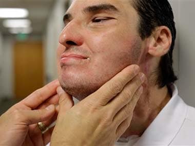 Richard Norris's skin is inspected by Dr. Eduardo Rodriguez, who led the surgical team that performed Norris’ face transplant: AP
