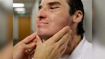 Won't take back trauma of disfigurement, says face transplant patient