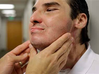 Won't take back trauma of disfigurement, says face transplant patient