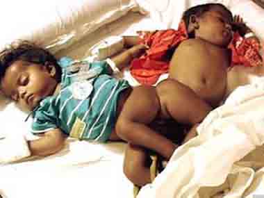 Conjoined twins born in Kerala Conjoined twins born in Kerala