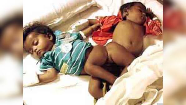 Conjoined twins born in Kerala