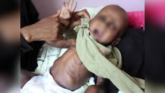 Every third child in Sunderbans is malnourished: Report