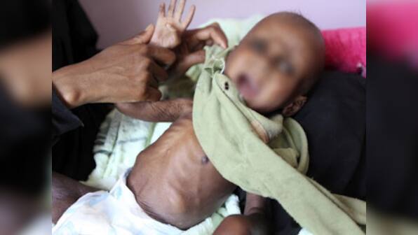 Every third child in Sunderbans is malnourished: Report