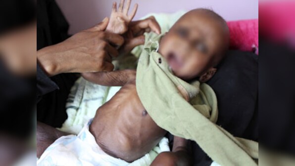 Every third child in Gujarat is underweight, says CAG report