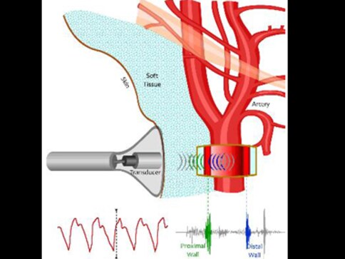 ARTSENS: How Indian technology is fighting heart disease ARTSENS: How Indian technology is fighting heart disease