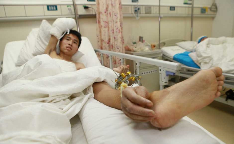 Photos: Doctors save man's hand by grafting it to his ankle Photos: Doctors save man's hand by grafting it to his ankle