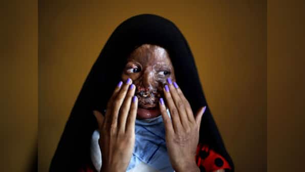 Law to prevent sale of acid ignored, say acid attack victims
