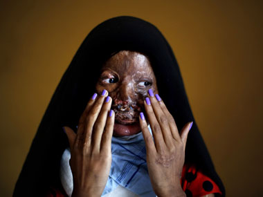 Law to prevent sale of acid ignored, say acid attack victims Law to prevent sale of acid ignored, say acid attack victims