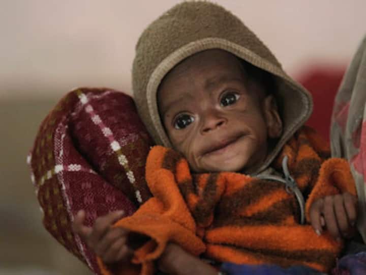 IIT Kharagpur researchers develop cheap ready-to-eat food paste for malnourished children IIT Kharagpur researchers develop cheap ready-to-eat food paste for malnourished children